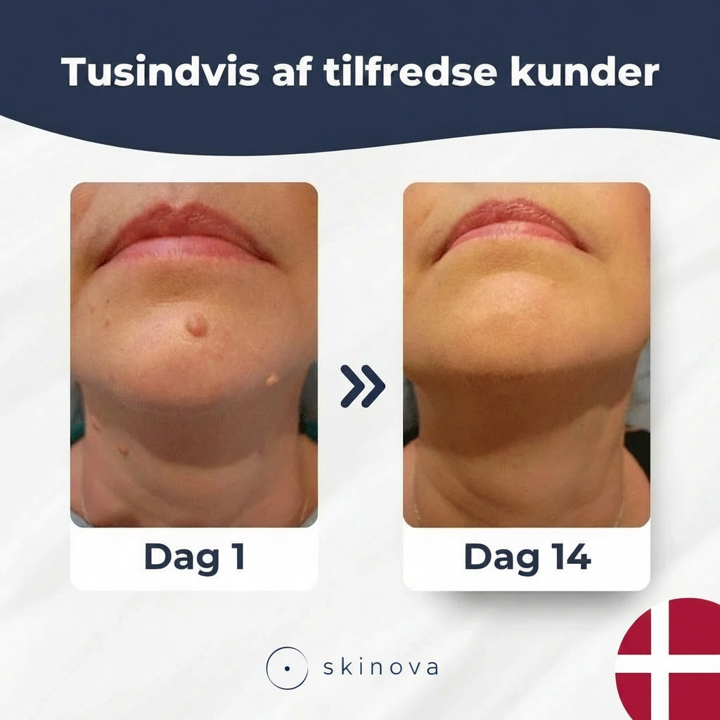 Skinovas fjernelse af hudflige