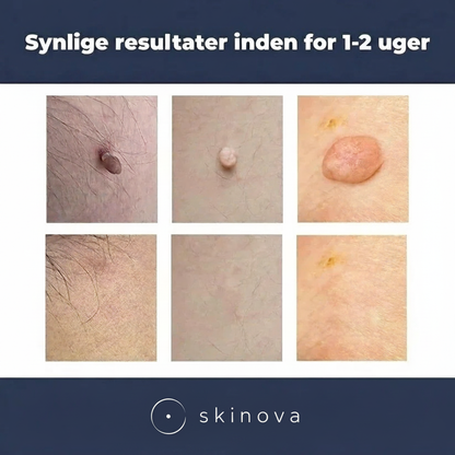Skinovas fjernelse af hudflige